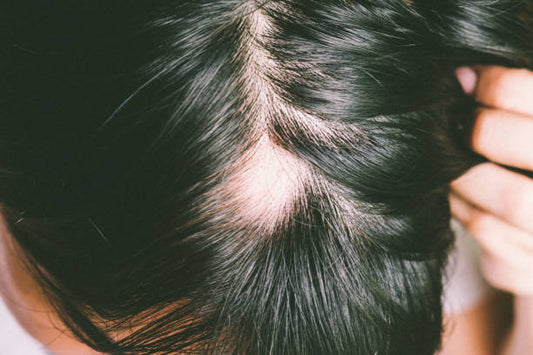 Alopecia Unveiled: Effective Treatments and Coping Strategies
