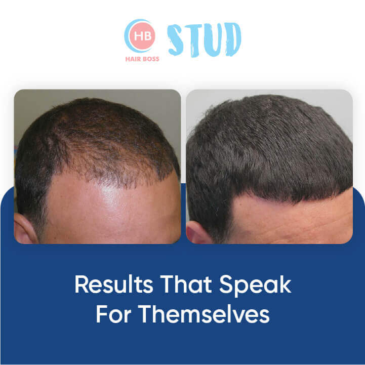 2X Stud Hair Growth Treatment For Men
